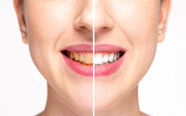 Teeth Whitening Milton Keynes Tamworth