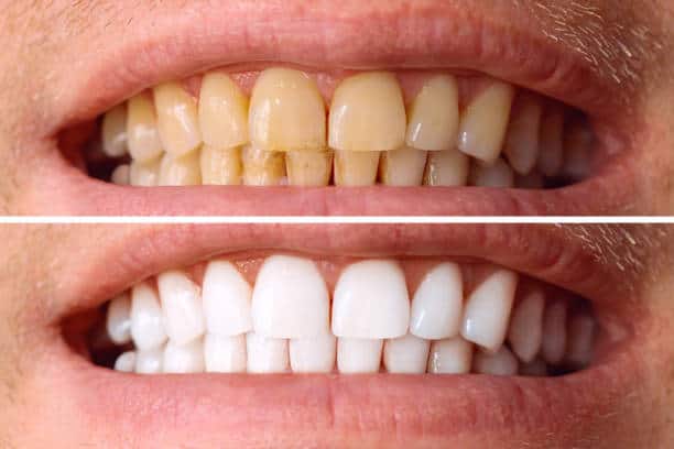 Laser White For Ever Bright – Get a Brighter, Whiter Smile with LA Teeth Whitening Tamworth