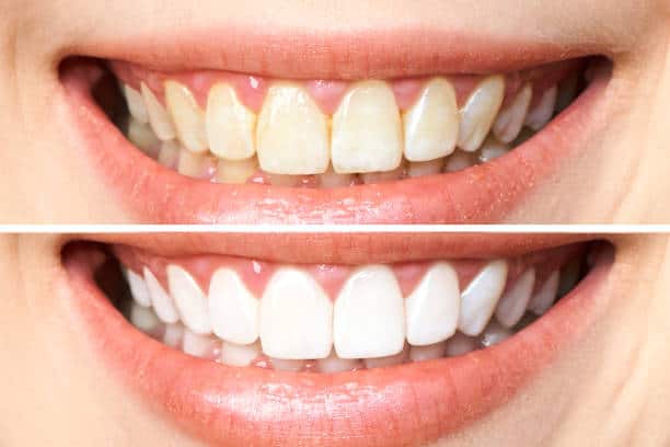 Achieve a Dazzling Smile for Your Special Day: A Guide to Wedding Teeth Whitening Tamworth