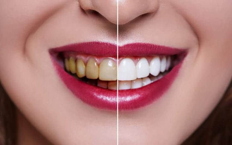 Teeth Whitening Ascot Windsor Tamworth