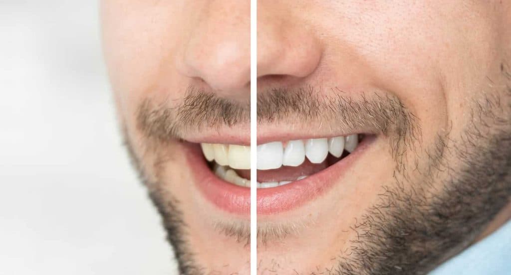 Teeth Whitening Bedfordshire Tamworth