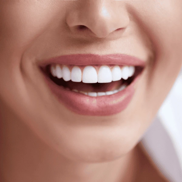 Get A whiter smile fast! Book with LA Teeth Whitening today! Tamworth