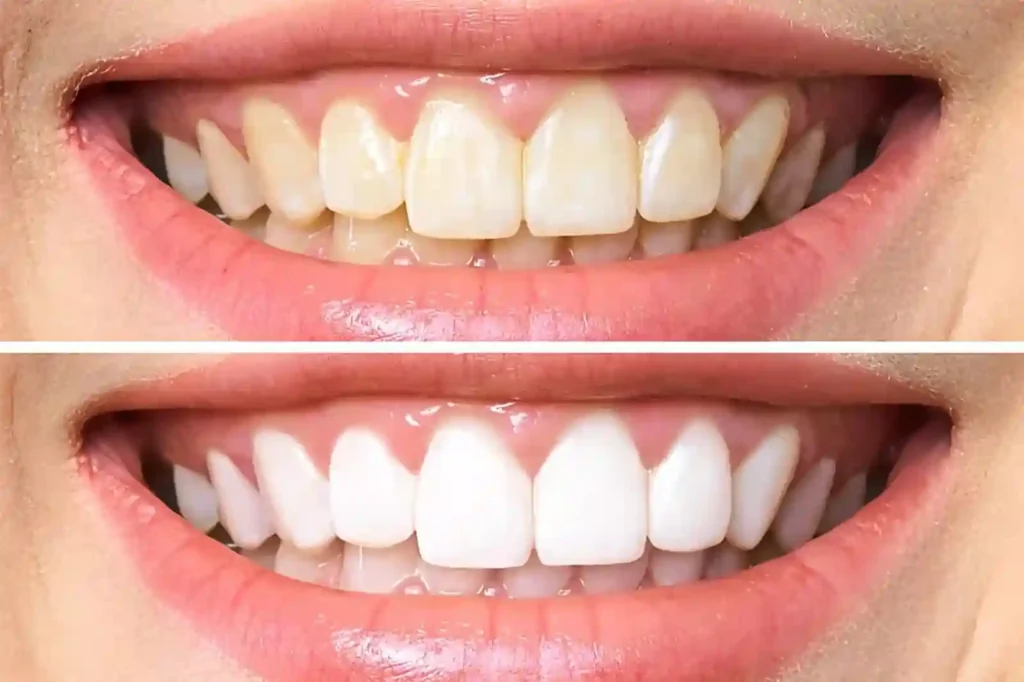 A before-and-after image showing gradual whitening results on teeth, maintaining a natural look Tamworth